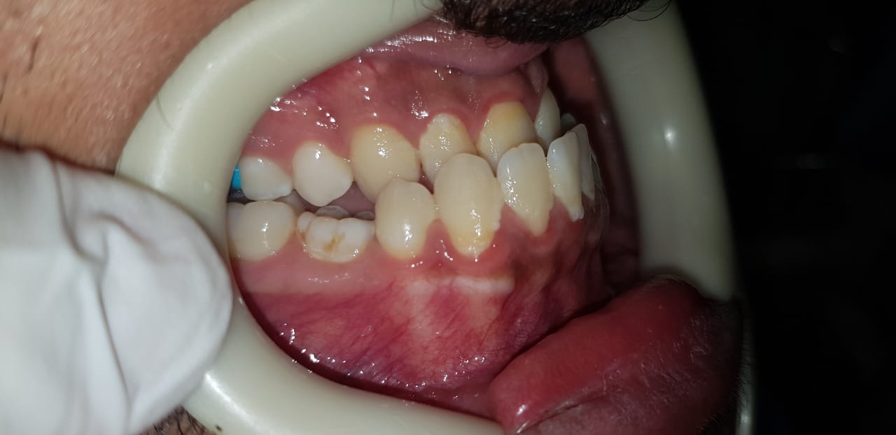 Butti Almari Pre Treatment Photo 2 Butti Almari Pre Treatment Photo 2