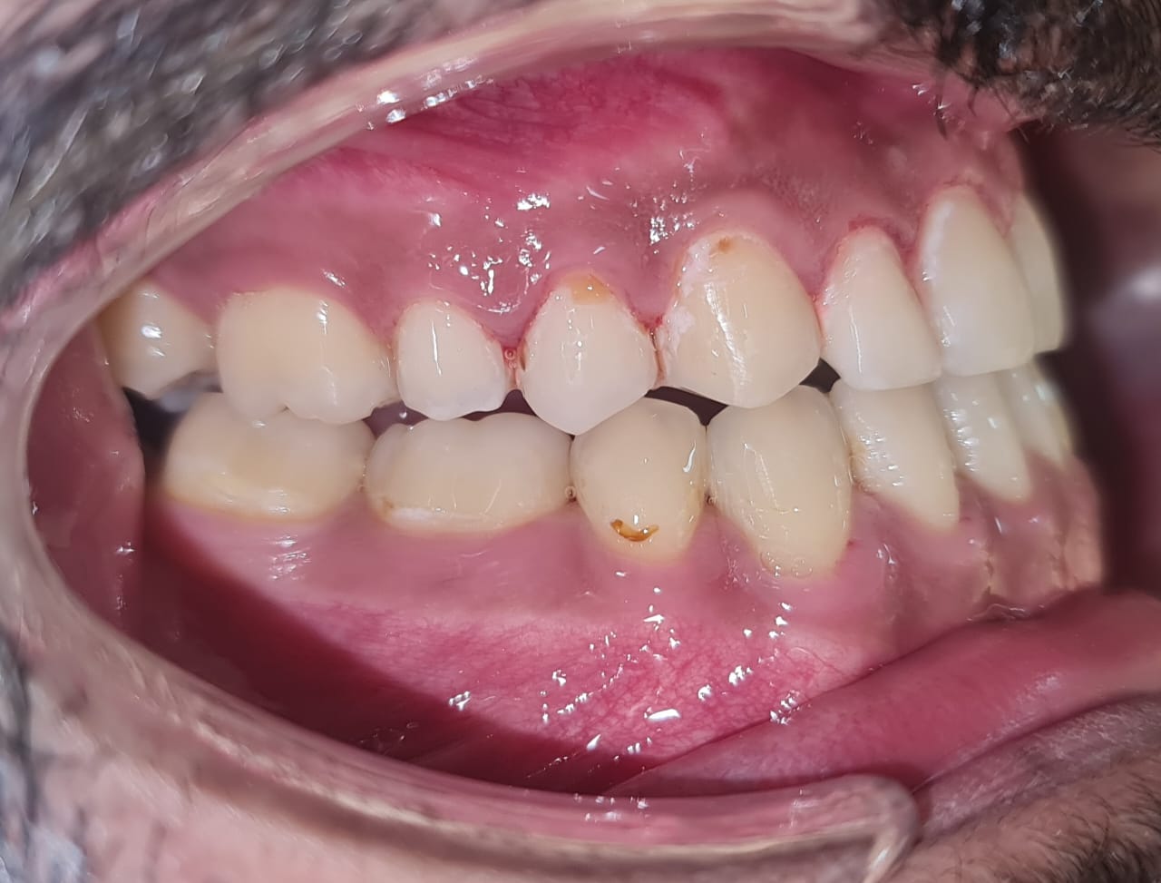 Butti Post Treatment Photo 2
