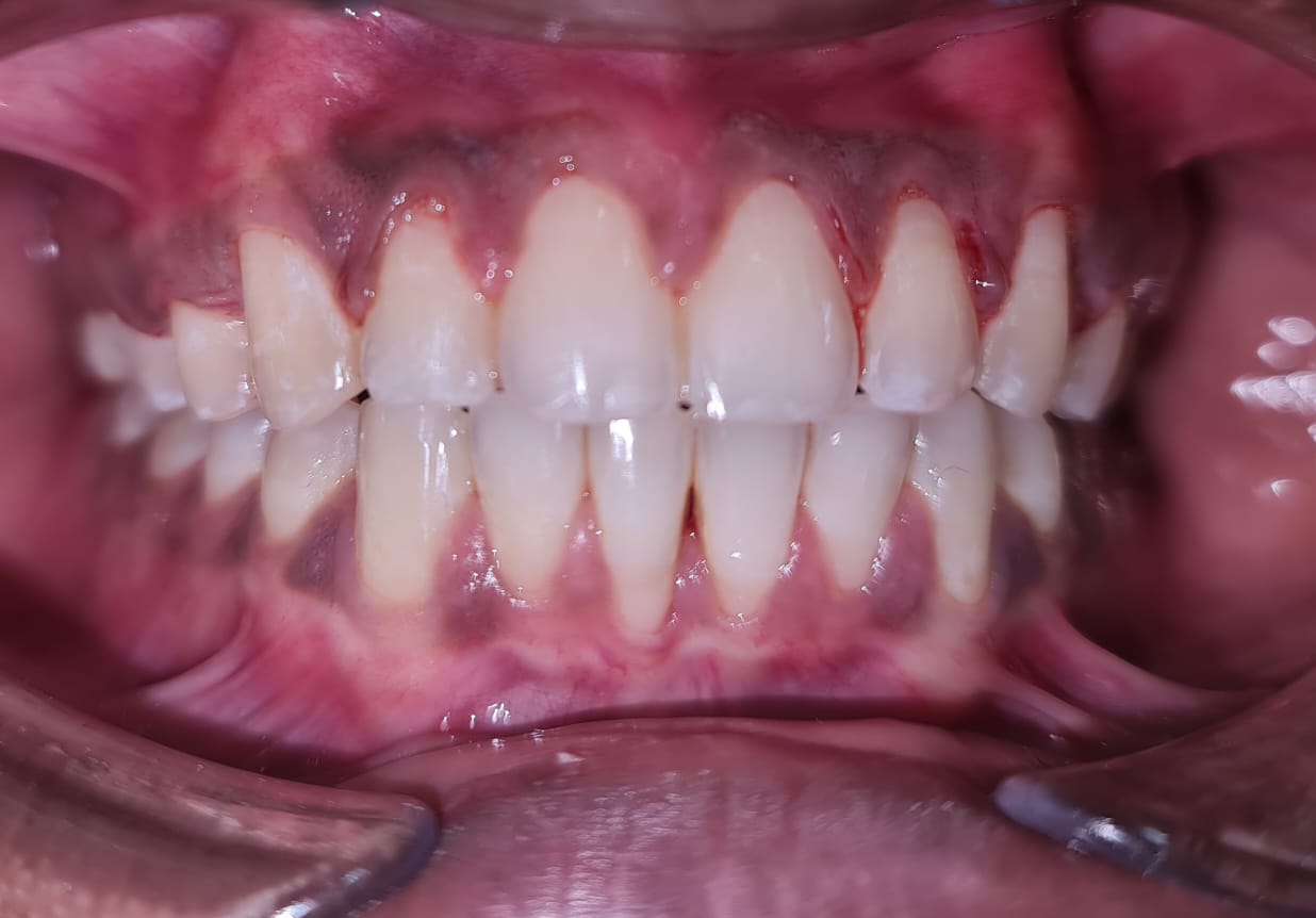 Nabirasool Pinjari Post Treatment Photo 1