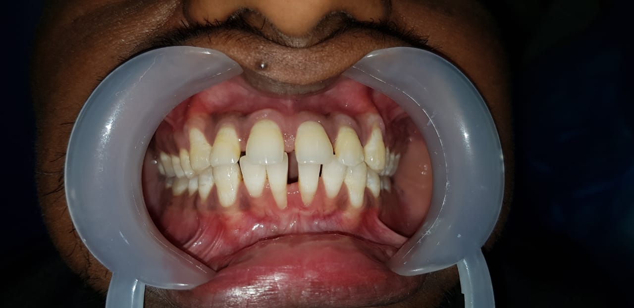 Nabirasool Pinjari Pre Treatment Photo 1 Nabirasool Pinjari Pre Treatment Photo 1
