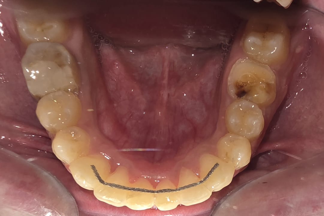 Post Treatment Photos 5